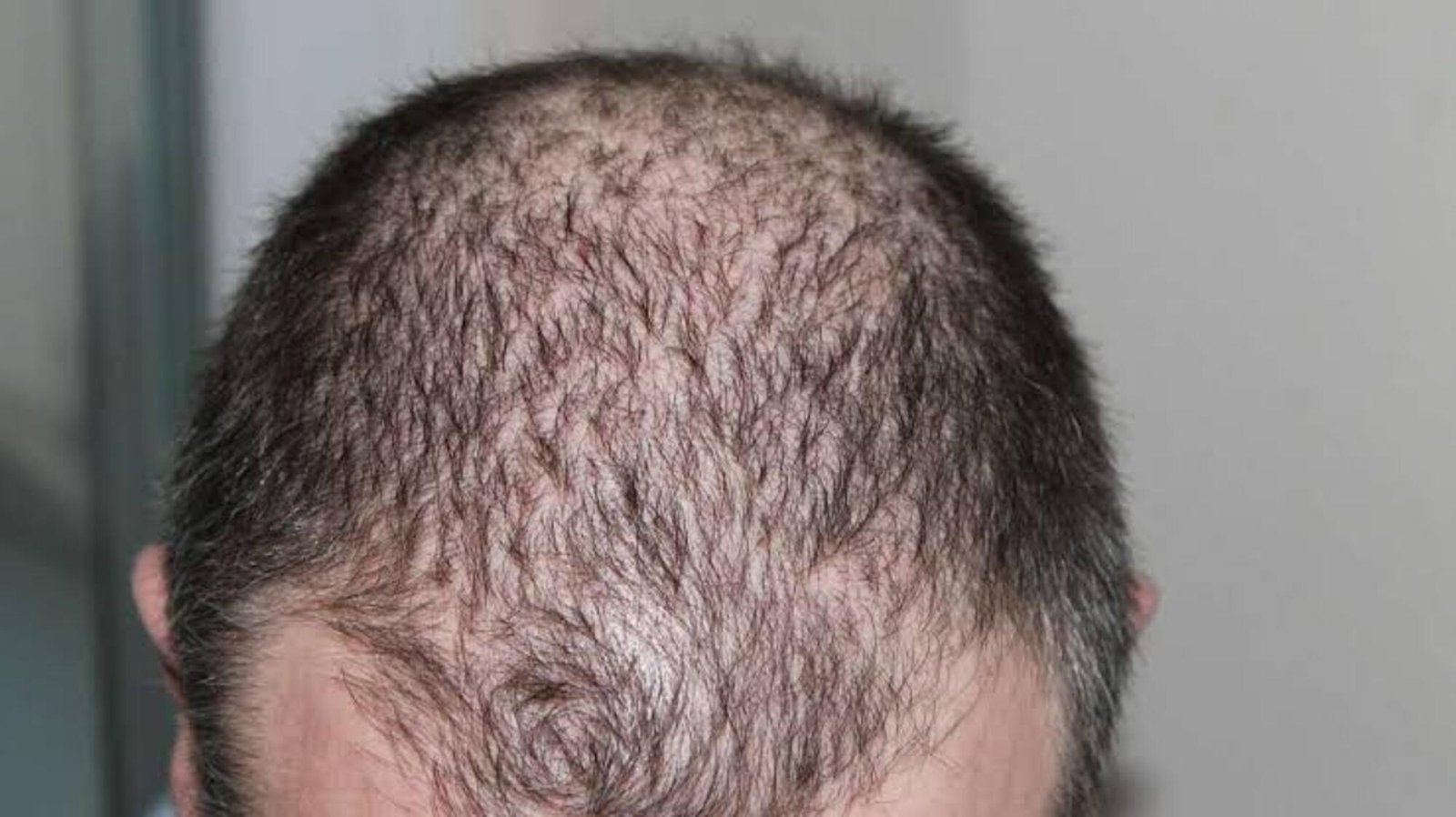 Hair loss