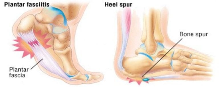 Heel pain