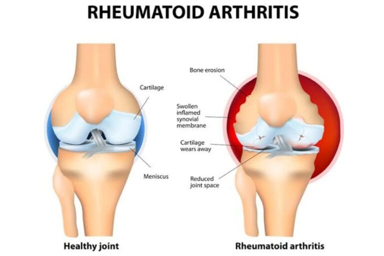 Rheumatoid arthritis